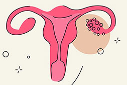 سندرم تخمدان پلی کیستیک