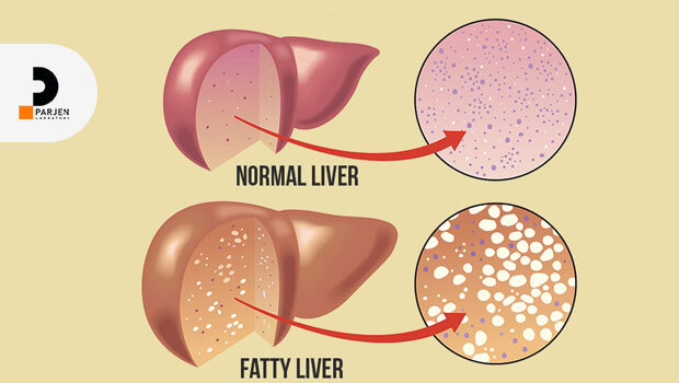 نارسایی حاد کبد