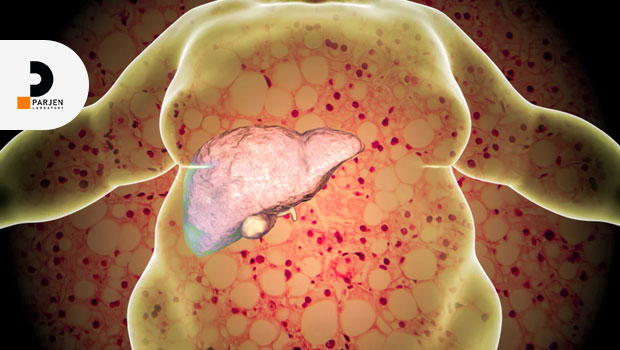 نارسایی حاد کبد