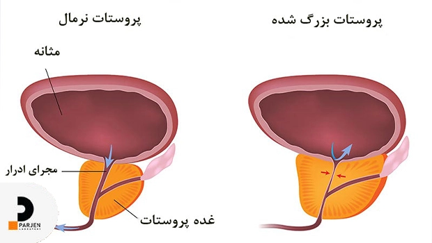 آزمایشات PSA
