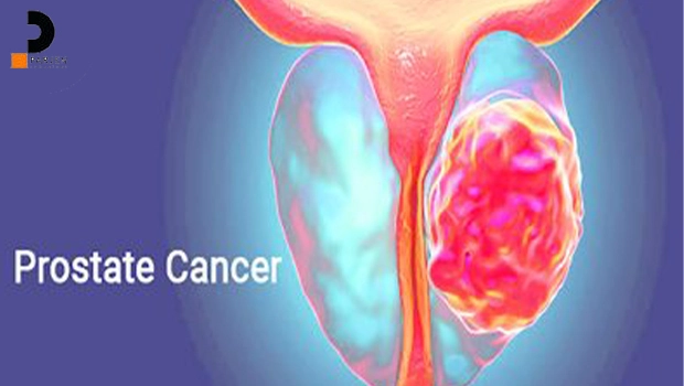 غربالگری سرطان پروستات (آزمایشات PSA)